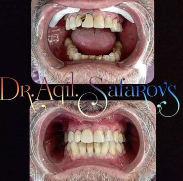 акция на установку брекетов: 🔥🔥🔥🎉Ramazan ayı ilə əlaqədər Kampaniya🎉🔥🔥🔥 Diş Həkimi Qiymətləri hələ — 3