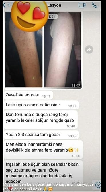 gen: GÜNƏŞ ÇİLİ VƏ LƏKƏLƏR ÜÇÜN LOSYON + SPF SETİ ☀️ Günəş ləkələri, çillər — 2