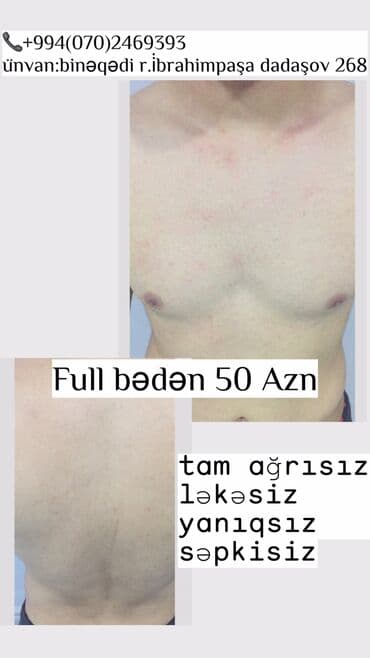 sari tukler ucun lazer: Kişilər üçün Lazer Epilasiya✅ Üz,Boyun,Boğaz,Qulaq,Burun = 10 AZN — 4