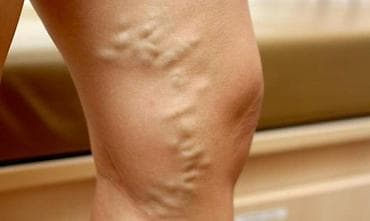 devalt lazer: Varikoz müalicəsi, Klinikada — 4