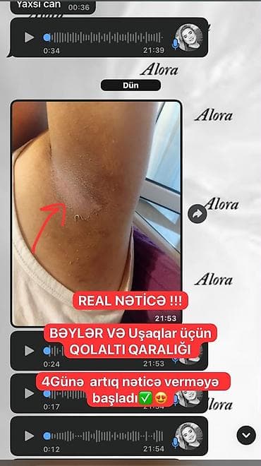 ucuz etir: ✨ QOLTUQALTI • BİKİNİ • DİZ • DİRSƏK ÜÇÜN AĞARDICI LOSYON ✨ — 5