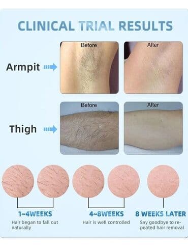 lazer işıq: Epilyasiya üçün, Buz lazer, Təlim keçirilir — 3