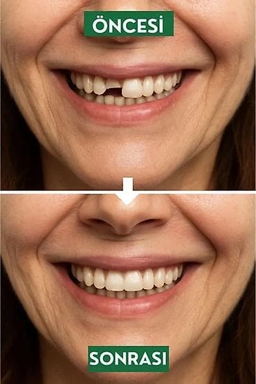 ustalar qrupu whatsapp: Qırılmiş cat, dişi duşmuş cixan protezlerin Hemin gun erzinde tez — 4