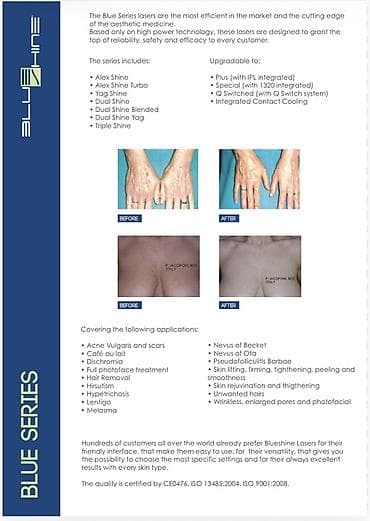 buz lazer: Epilyasiya üçün — 2