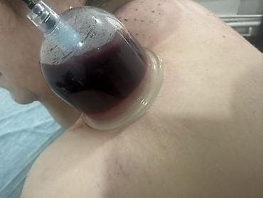 Красота и здоровье: Hirudoterapiya və Hicama (Qan çıxarma) xidməti - Hirudoterapiya — 7