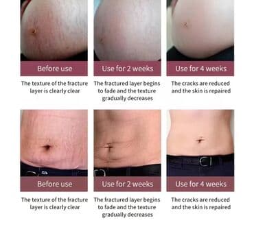 крем барои нараки руй: Çat kremi orginal Krem hamiləlik arıqlama və ya artım nəticəsində — 3