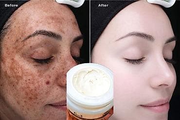 leke ucun maskalar: Kosmetik dəst, >10 məhsul — 1