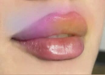 dermapen qiymeti: Plastik estetik hər yüksək səviyyə uyğun qiymət!!!Burdan mesaj — 4