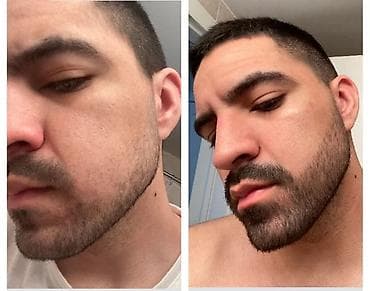 Kosmetika: Saqqal çıxaran Serum+ rollik saç ve Saqqalda olan seyrek yerler — 8