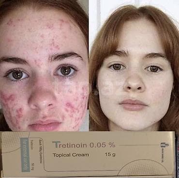 uzdeki sizanaqlar ucun derman: Üz kremi, Problemli dəri üçün, 20 ml, Yeni, Ödənişli çatdırılma — 1