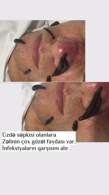 sari tukler ucun lazer: Bəylər üçün = Hicama Və Zəli ✅Zəlinin Faydaları(Hirudoterapiya) — 3