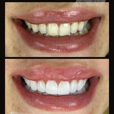 акция на установку брекетов: Stomatoloji xidmetler tam steril ve muasir. dislerin plomblanmasi — 5