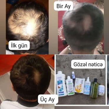 Saç tökülməsinin kökündən həlli. Həm daxildən qida əlavələri qəbul