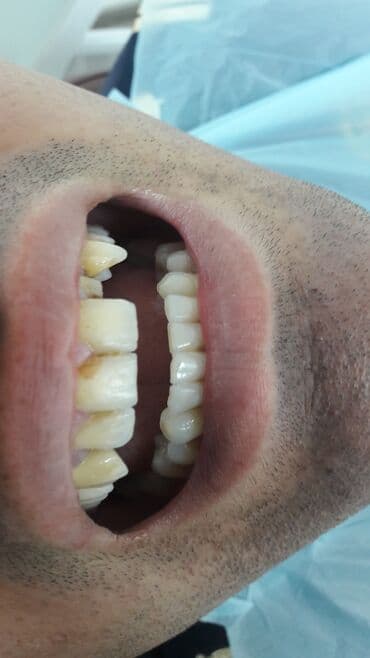 акция на установку брекетов: Stomatoloji xidmetler tam steril ve muasir. dislerin plomblanmasi — 13