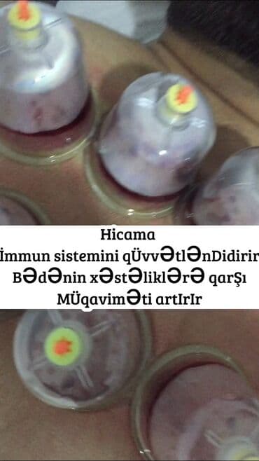 ağ dırnaq modelleri: Hicamanın Faydaları✅ *Qan dövranın pozulması *Qanın təmizlənməsi — 8