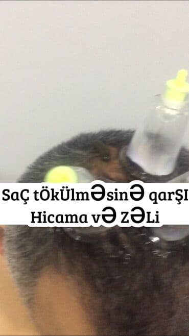 ağ dırnaq modelleri: Hicamanın Faydaları✅ *Qan dövranın pozulması *Qanın təmizlənməsi — 4