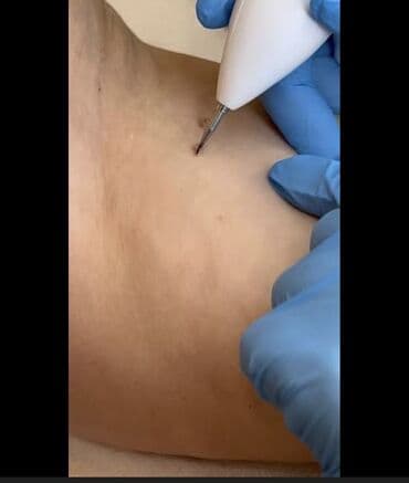 qaqa sac stili: Ət xallarin və ziylərin apparatla goturulməsi. Diş daşlarinin — 2