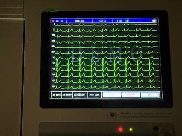 Elektrokardioqraf (EKQ) aparatı Contec ECG1200G. 12 kanallı, tam idial — 4