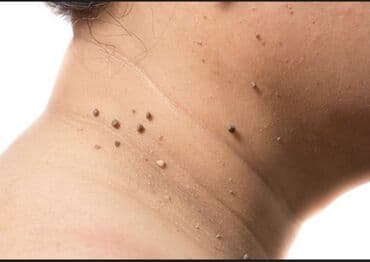 qaqa sac stili: Ət xallarin və ziylərin apparatla goturulməsi. Diş daşlarinin — 1