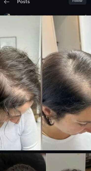 таблетки для похудения в баку: Saç üçün yağ, Saç tökülməsinə qarşı — 8