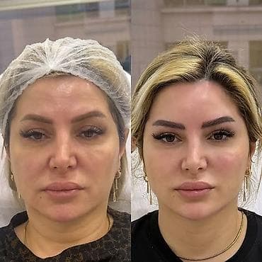 Son model lazer cihazla - Dərinin sıxlığının artırılması, incə