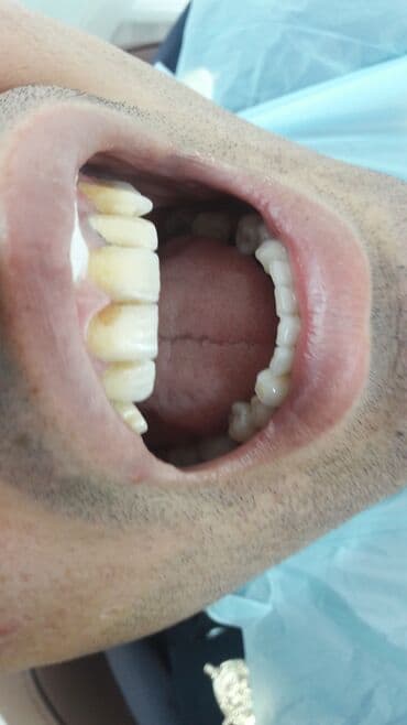 акция на установку брекетов: Stomatoloji xidmetler tam steril ve muasir. dislerin plomblanmasi — 12