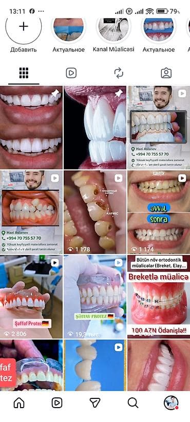 avtomobil yuma: İndi Daha Rahat və Estetik 💠 Qiymətlər Estetik plomb (1 diş) – 50₼ — 1