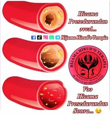 bioloji yaşam sağlamlıq mərkəzi: 📌hi̇cama nədi̇r❓ 🔷️qanalma ilə müalicə üsulu olaraq. Xəstəliklərə — 2