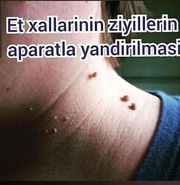 Xidmət: Hicama, zəli qoyulması və aparatlа dəri törəmələrinin — 3