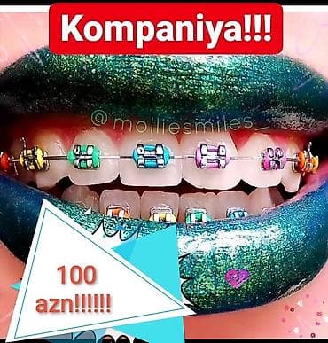 акция на установку брекетов: İnstaqram dr.zerif). Seçilən pasientlerə sonda kappa hədiyyə — 2