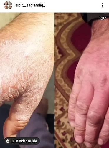 Deri xestelikleri.sac tokulmesi.kecellesme.kepek.ayaqda qribok.iy