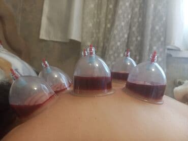 ремонт домашних телефонов на дому: Hicama proseduru üçün istifadə olunan tibbi bankalar. Bu bankalar — 7