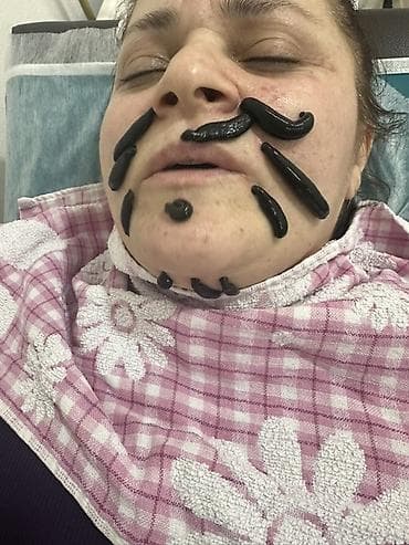 Красота и здоровье: Hirudoterapiya və Hicama (Qan çıxarma) xidməti - Hirudoterapiya — 8