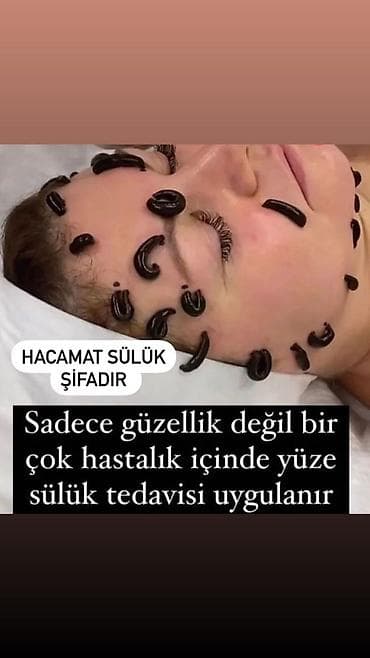 Обучение, курсы: Xidmət: Hacamat və sülük terapiyası Təsvir: - Bədəndə seçilmiş — 2