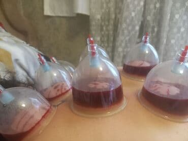 ремонт домашних телефонов на дому: Hicama proseduru üçün istifadə olunan tibbi bankalar. Bu bankalar — 8