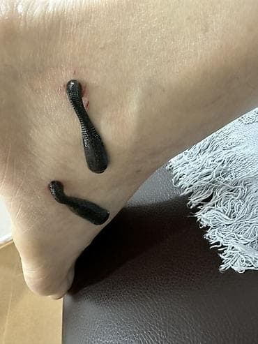 Красота и здоровье: Hirudoterapiya və Hicama (Qan çıxarma) xidməti - Hirudoterapiya — 3