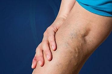 devalt lazer: Varikoz müalicəsi, Klinikada — 5