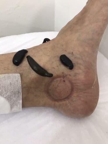 Медсестры: Xidmət: Hicama, zəli terapiyası və dəri törəmələrinin (balaca — 2