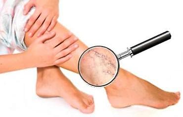 Услуги: Лечение варикоза, В клинике — 3