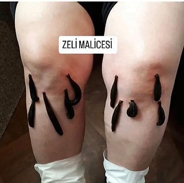 Xidmət: Hacamat və sülük terapiyası Təsvir: - Bədəndə seçilmiş