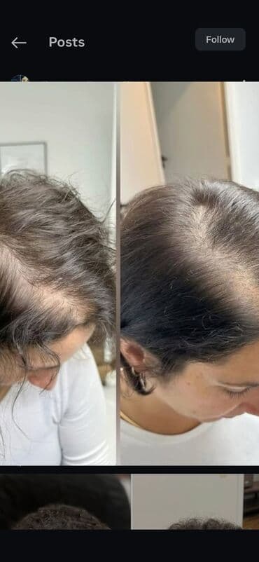 таблетки для похудения в баку: Saç üçün yağ, Saç tökülməsinə qarşı — 2