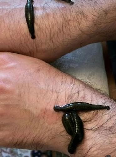 Обучение, курсы: Xidmət: Hacamat və sülük terapiyası Təsvir: - Bədəndə seçilmiş — 4