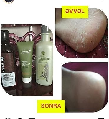 gumus sepler: Deri xestelikleri.sac tokulmesi.kecellesme.kepek.ayaqda qribok.iy — 6