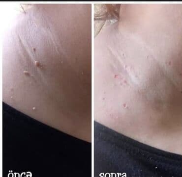 qaqa sac stili: Ət xallarin və ziylərin apparatla goturulməsi. Diş daşlarinin — 4