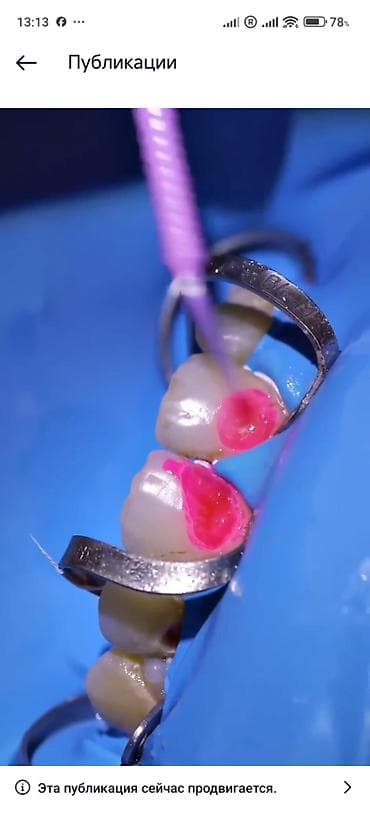 avtomobil yuma: İndi Daha Rahat və Estetik 💠 Qiymətlər Estetik plomb (1 diş) – 50₼ — 5