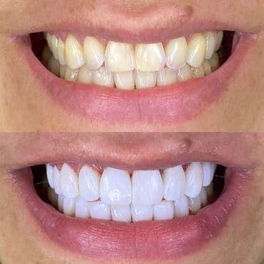 акция на установку брекетов: Stomatoloji xidmetler tam steril ve muasir. dislerin plomblanmasi — 8