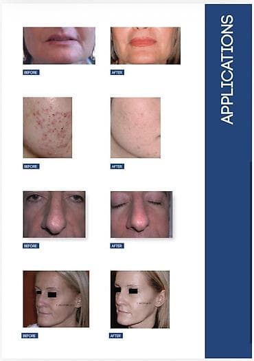 buz lazer: Epilyasiya üçün — 3