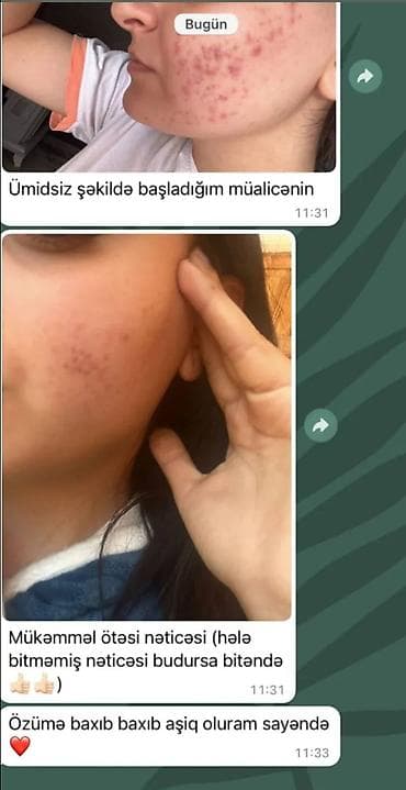 ucuz etir: SIZANAQ SETİ! 🔥 Sızanaq, qara nöqtə və ləkələrdən bezmisiniz? Təbii — 4