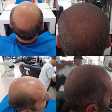 sac tokulməsinə qarşı vitamin: Saç üçün yağ, Hər növ saçlar üçün, Yeni, Pulsuz çatdırılma — 2