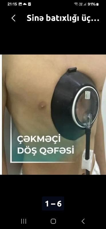 tib: Sinə batixligi ŭçŭn vakum. uşaglarda vakumlu döş gəfəsi — 2
